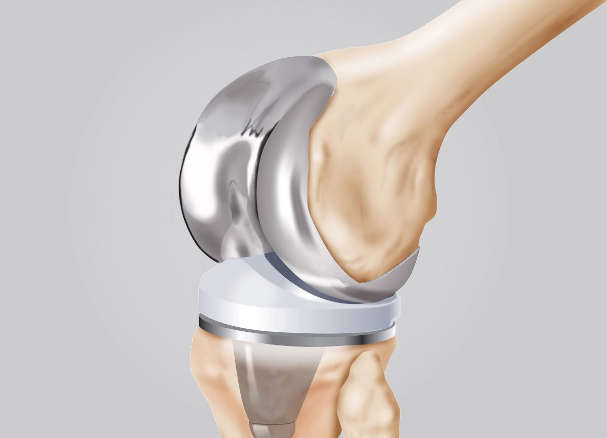 protesi ginocchio con ossa