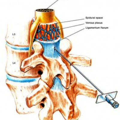 infiltrazioni alla schiena - spazio epidurale