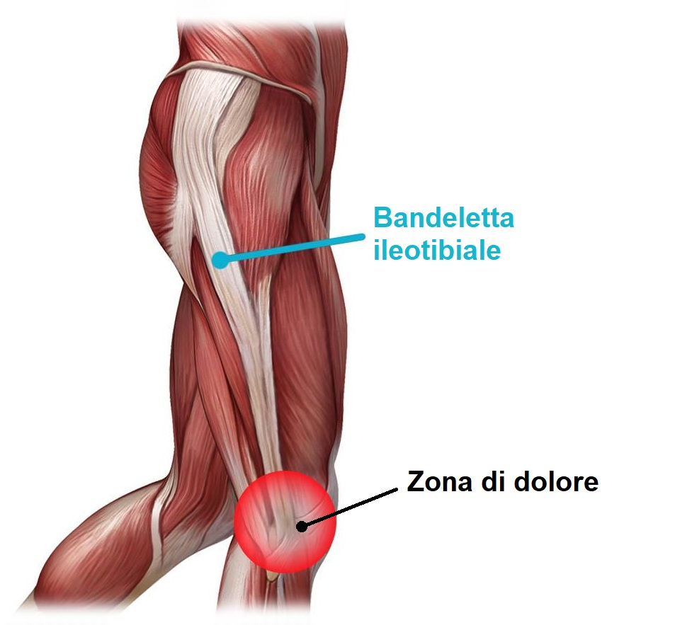 Sindrome della Bandelletta Ileotibiale